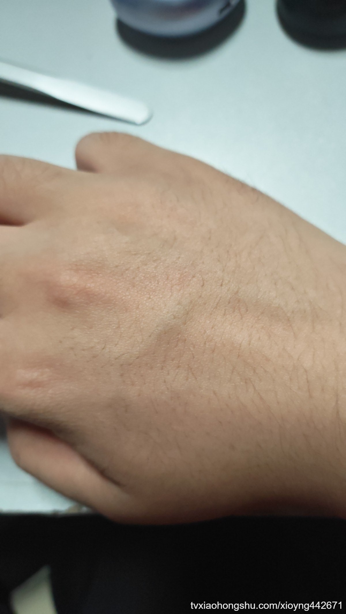 血管凸出来，特别明显，不知道为什么 - 私房ACG - sifacg.com